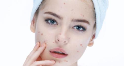 臉上長痘是什么原因 長痘痘了怎么辦 痘痘肌膚怎么改善