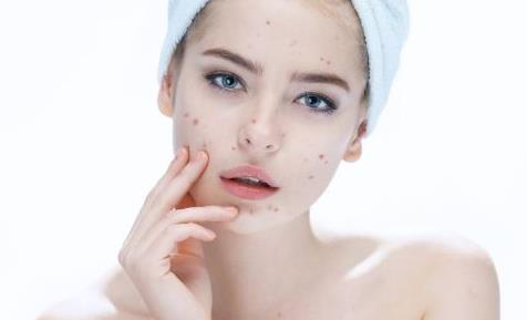 臉上反復(fù)長痘痘的原因及解決方法 洗臉去痘小訣竅