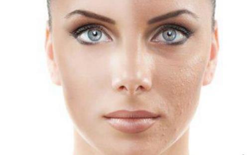 不同問題引起的毛孔粗大問題處理方法 縮毛孔小妙招