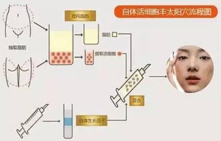 如何提高豐顳術的自體脂肪成活率