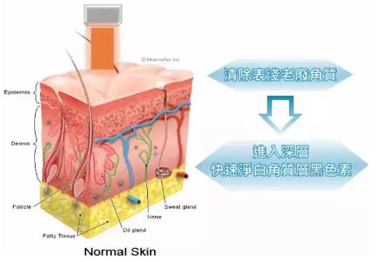 北京伊美爾紫竹醫院:光子嫩膚多久做一次