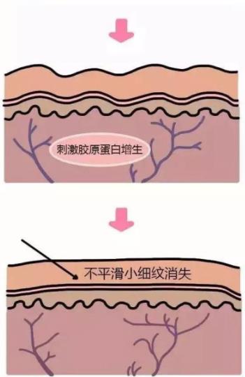 北京伊美爾紫竹醫院:光子嫩膚多久做一次