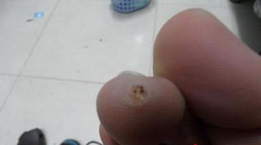 雞眼剛開始的圖片及初期癥狀、雞眼的形成原因及治療方法