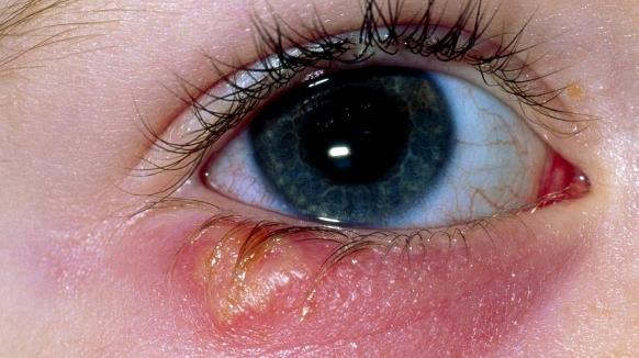 眼睛里有紅血絲的原因有哪些?眼睛的日常護理有哪些?