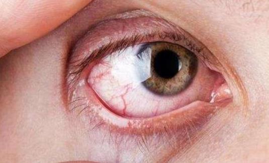 眼睛里有紅血絲的原因有哪些?眼睛的日常護理有哪些?