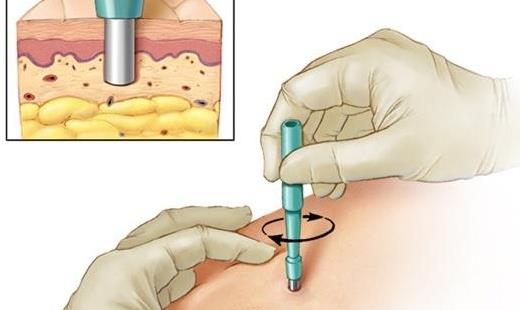 毛囊炎有哪些分類?患毛囊炎需要做哪些檢查?