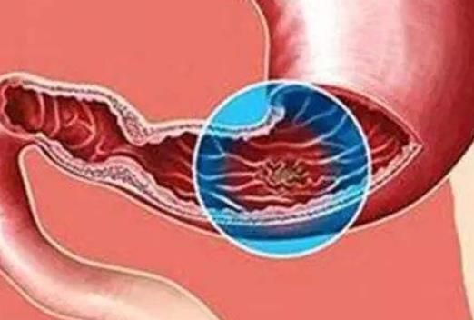 胃穿孔的原因及癥狀有哪些?胃穿孔有哪些急救措施?