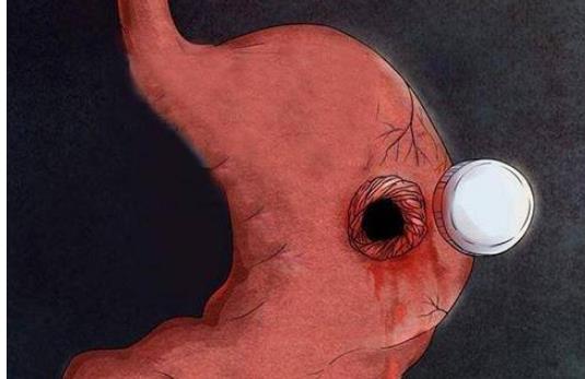 胃穿孔有哪些治療方式?胃穿孔有哪些檢查方式及怎么預防?