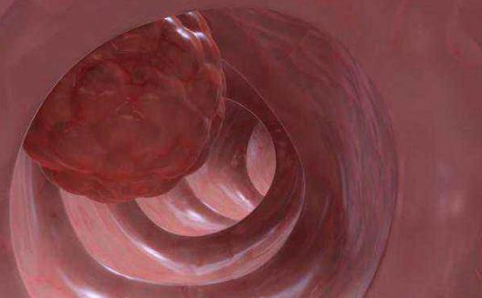 患直腸癌有哪些癥狀?直腸癌有哪些分類?