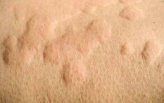 蕁麻疹有哪些危害?引起蕁麻疹的原因有哪些?