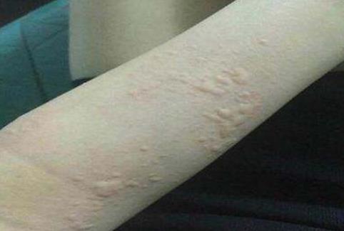 蕁麻疹有哪些危害?引起蕁麻疹的原因有哪些?