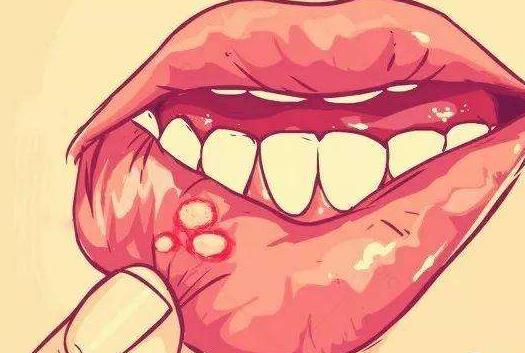 口腔潰瘍有哪些危害?口腔潰瘍的人吃什么好?