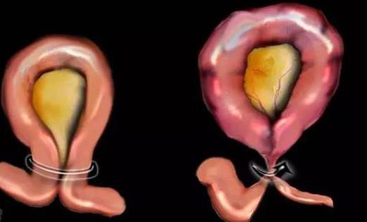 什么是腹內疝?腹內疝需要做哪些檢查?