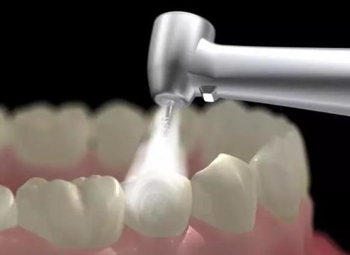 孕期洗牙對胎兒有影響嗎?洗牙對牙齒傷害大嗎