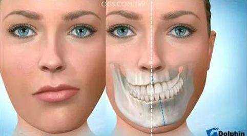 聯合麗格第一醫院柳春明教授告訴你什么是正頜手術的手術優先