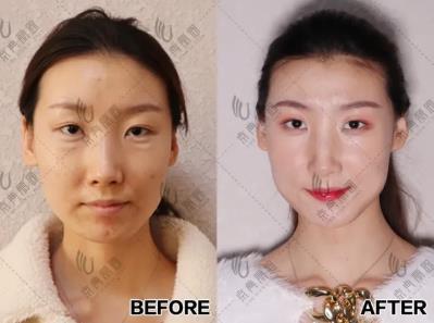 京典麗園不開刀去眼袋 搞清區(qū)別對癥下藥告別眼袋困擾!