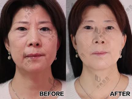 京典麗園不開刀去眼袋 搞清區(qū)別對癥下藥告別眼袋困擾!