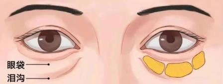 京典麗園不開刀去眼袋 搞清區(qū)別對癥下藥告別眼袋困擾!