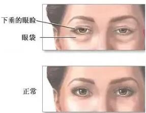 京典麗園不開刀去眼袋 搞清區(qū)別對癥下藥告別眼袋困擾!