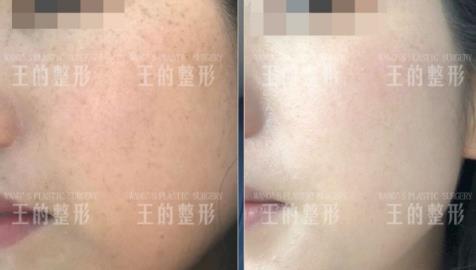 王的整形王鳳波親授光子嫩膚百搭攻略