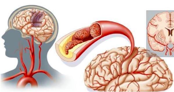 【心血管咨訊】腦梗康復訓練方法 一鍵get