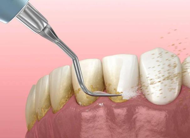 牙結(jié)石不洗牙有別的方法嗎?洗牙結(jié)石一次能完全洗干凈嗎