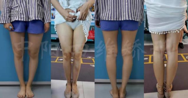 綁腿可以矯正O型腿嗎?武漢中陽醫院四維矯形技術七天矯正腿型異常