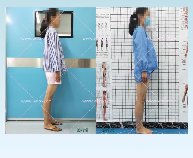 綁腿可以矯正O型腿嗎?武漢中陽醫院四維矯形技術七天矯正腿型異常