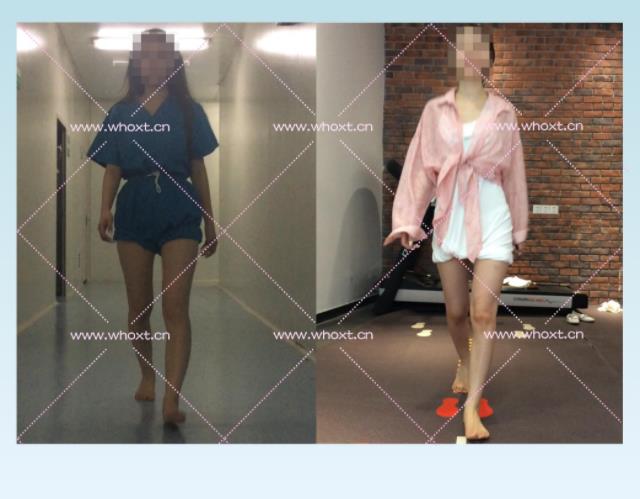 綁腿可以矯正O型腿嗎?武漢中陽醫院四維矯形技術七天矯正腿型異常