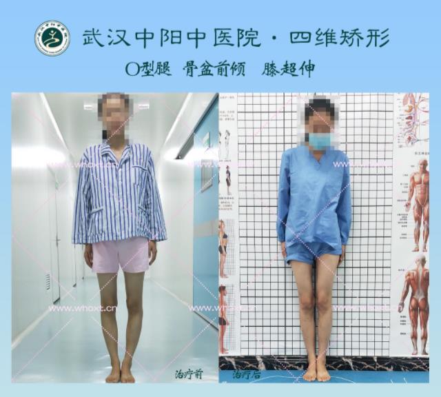 綁腿可以矯正O型腿嗎?武漢中陽醫院四維矯形技術七天矯正腿型異常