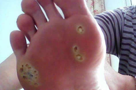 雞眼的癥狀圖片長什么樣子位置 雞眼挖出來的根部肉刺圖片 雞眼是怎么形成的:雞眼癥狀及如何辨別(圖)