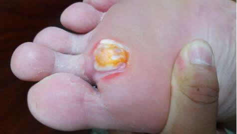 雞眼的癥狀圖片長什么樣子位置 雞眼挖出來的根部肉刺圖片 雞眼是怎么形成的:雞眼癥狀及如何辨別(圖)