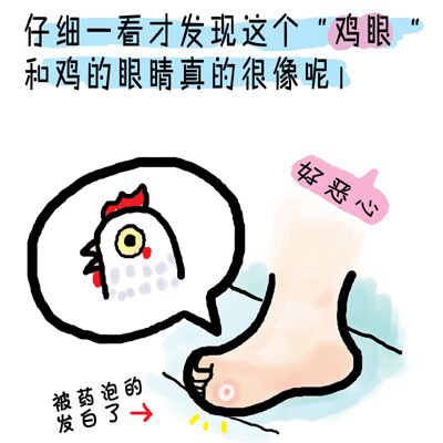 為什么長雞眼會傳染嗎 腳上的雞眼位置圖片怎么根治