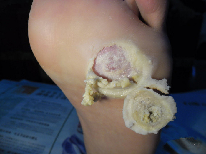 為什么長雞眼會傳染嗎 腳上的雞眼位置圖片怎么根治