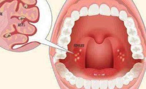 咳嗽噴出一塊石頭 石頭原來從這里來