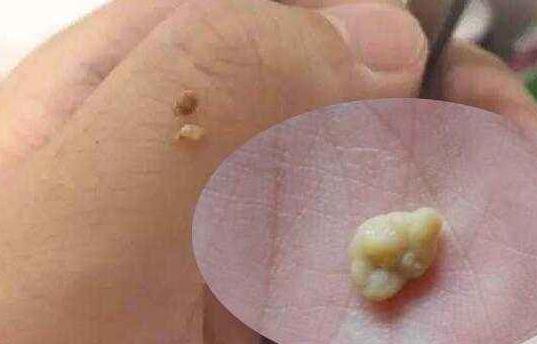 咳嗽噴出一塊石頭 石頭原來從這里來