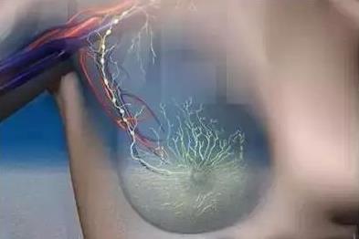 乳房纖維瘤怎么治療 乳房纖維瘤怎么消除