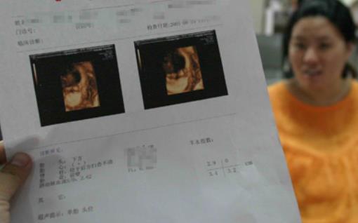 三維彩超什么時候做比較合適 做三維彩超最佳時間