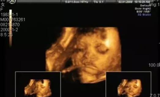 三維彩超什么時候做比較合適 做三維彩超最佳時間