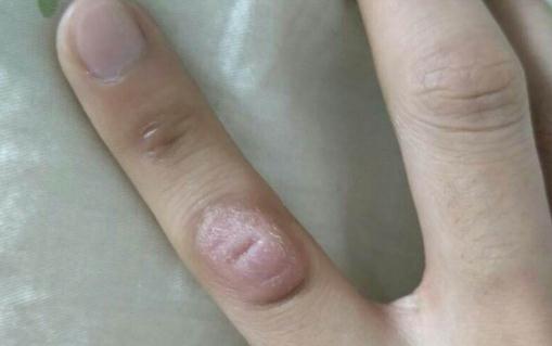 手指關節鼓個硬疙瘩圖片 手指關節鼓個硬疙瘩怎么治