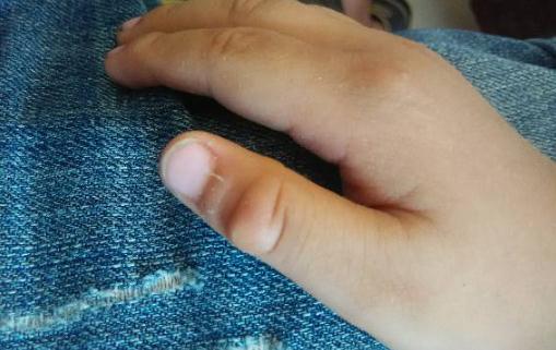 手指關節鼓個硬疙瘩圖片 手指關節鼓個硬疙瘩怎么治