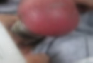 (男子嘿咻九鋼環套蛋 睪丸腫如橘子險絕后.jpg