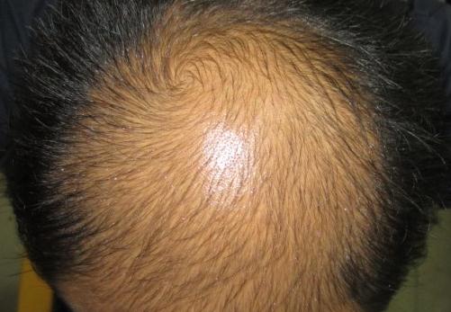 所謂“養(yǎng)腎補腎”防脫發(fā),風牛馬不相及