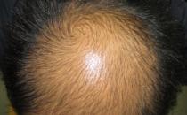 所謂“養腎補腎”防脫發，風牛馬不相及