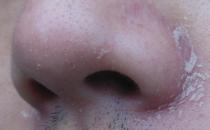 秋季鼻子兩側為何會干癢脫皮