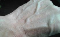 青筋凸出是病癥 正確調理保健康