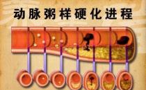 什么是“動粥”？哪些是“動粥疾病”高危人群？