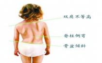 如何盡早發現孩子脊柱側彎？