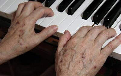 長了老年斑就別再暴曬了!危險