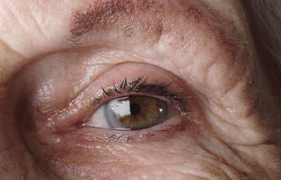 老人患上白內障的癥狀是什么